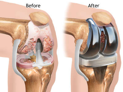 Joint replacement surgery